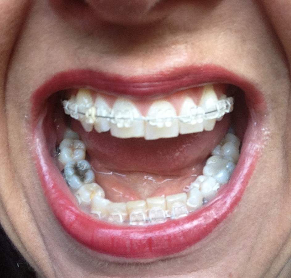 A Journey with my Teeth Broken Braces Wednesday 4th May 2016