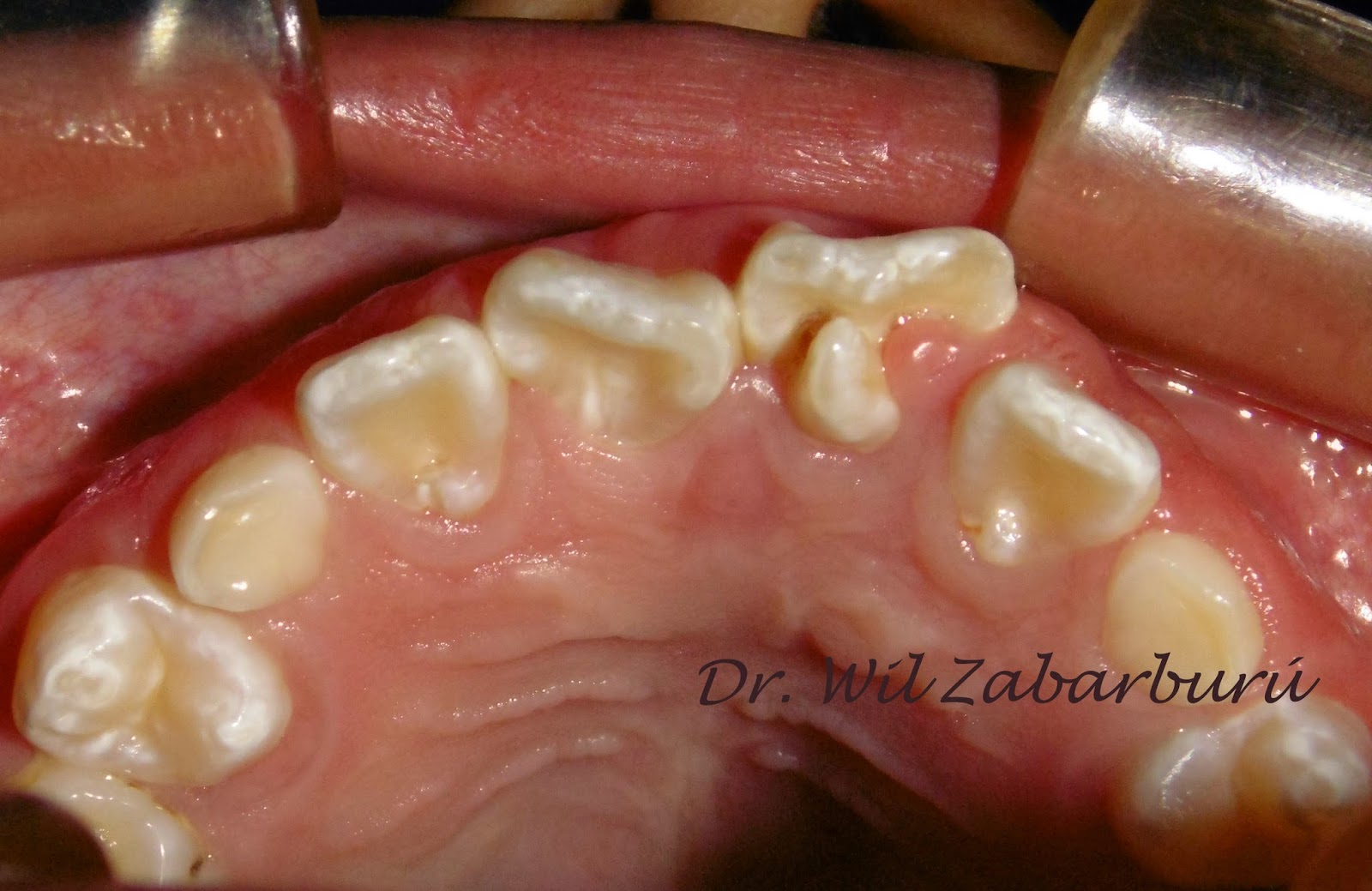 CLINICA DENTAL ASISTENCIAL TALÓN CUSPÍDEO