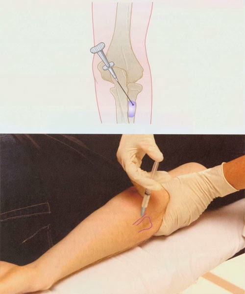 Tenon Injection Biceps Tendon Insertion Injection ~ Nursing