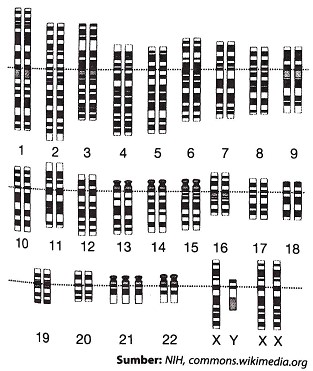 Perhatikan gambar kariotipe sindrom Down berikut. Berdasarkan gambar
