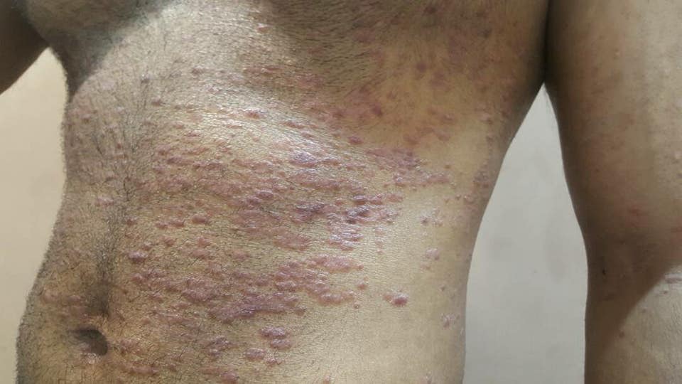 Psoriasis and ayurveda. eczema ayurveda twacha rog ayurveda.