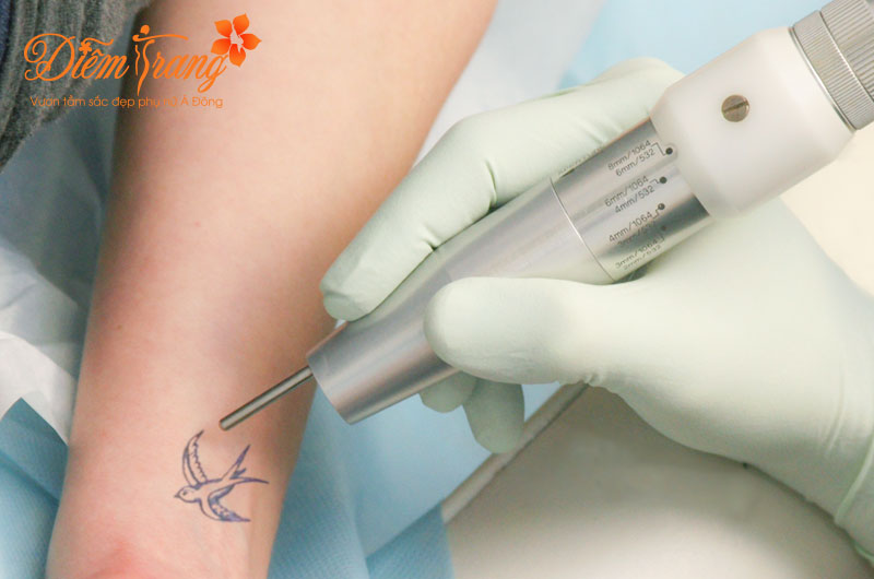 Xóa hình xăm giá rẻ tại TPHCM Xóa hình xăm giá rẻ tại TPHCM