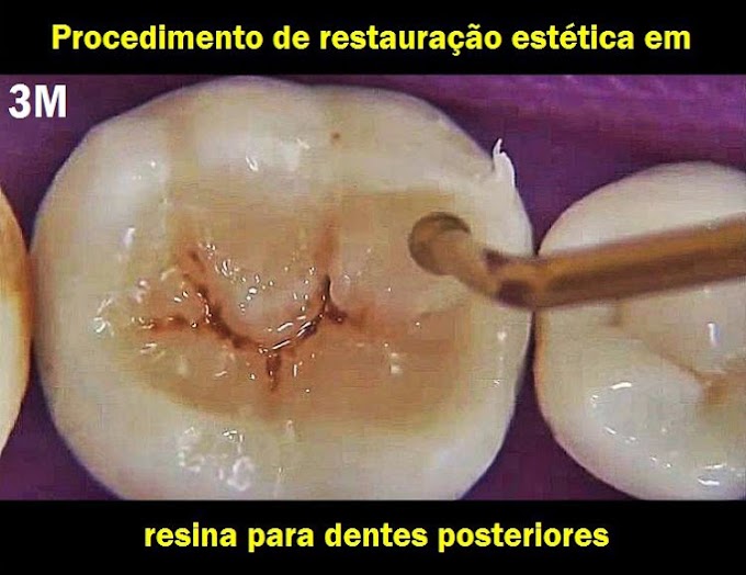 DENTÍSTICA: Procedimento de restauração estética em resina para dentes posteriores - 3M