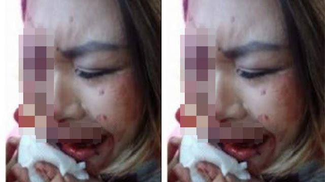 Kasihan Wanita Indonesia ini Dipukuli di korea Karena Perlakuan Diskriminasi 