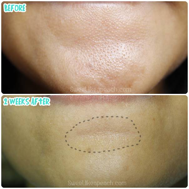 How To Clear Whiteheads On The Chin Stylonomics