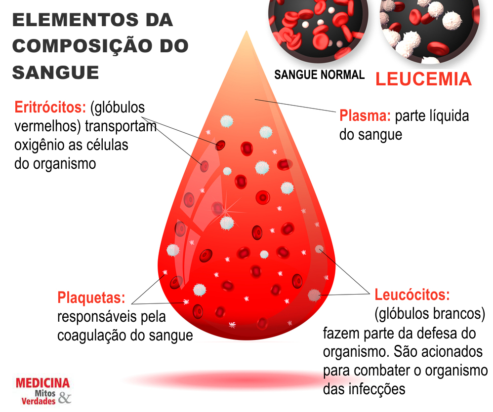 Leucemia Câncer No Sangue De Causas