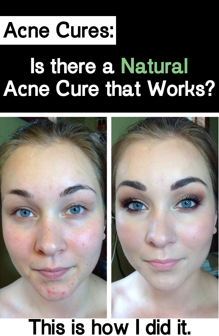 Natural Skin Healing Acne Cures This is how I did it.