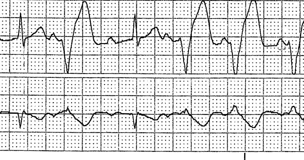 ECG Rhythms Isorhythmic AV dissociation SR + VT