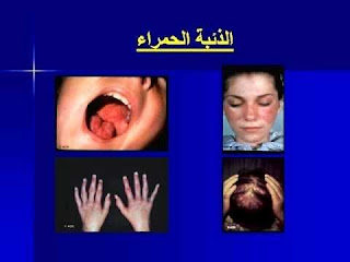 خلطات طبيعية رائعة لعلاج مرض الذئبة الحمراء