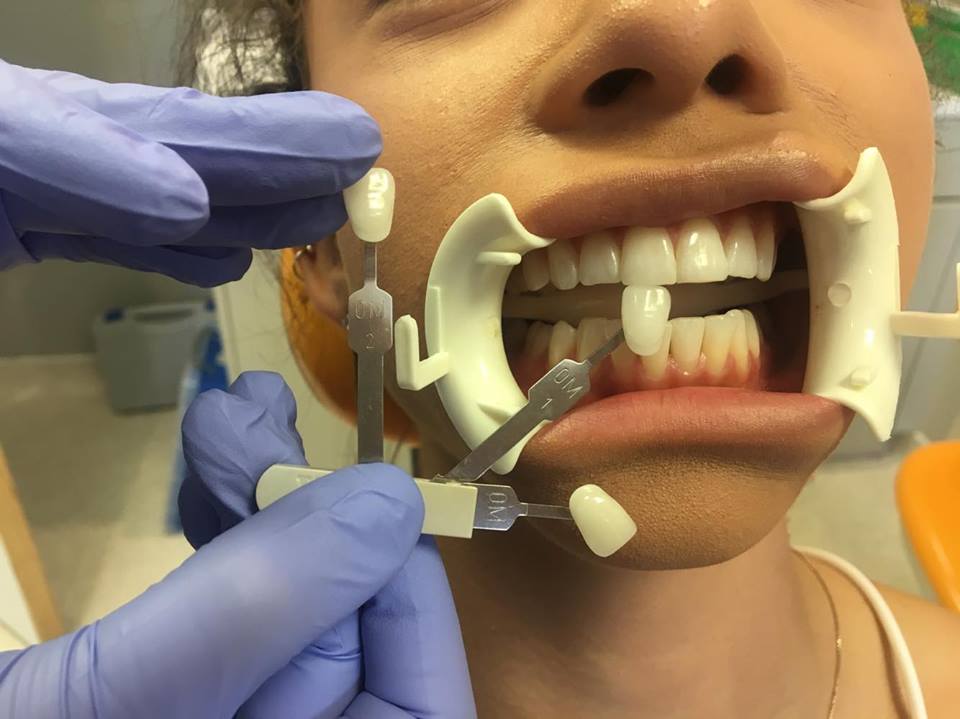 New Nashers Enlighten Teeth Whitening Review — The Southampton Girl