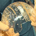 Implantan exitosamente cráneo impreso en 3D