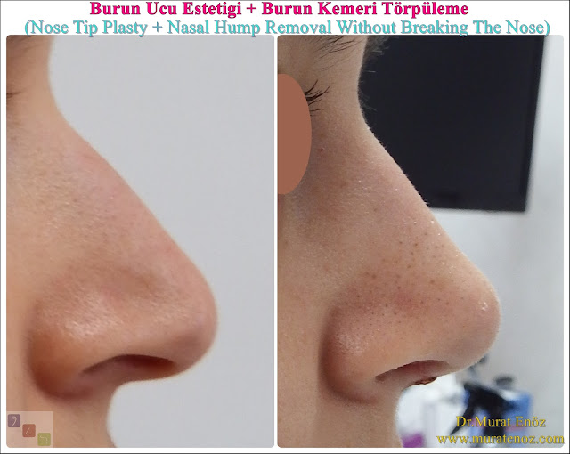 Rhinoplasty Without Breaking Nasal Bone - Rhinoplasty Without Breaking Nasal Bone - Female Nose Aesthetic Surgery - Nose Jobs For Women - Nose Reshaping for Women - Best Rhinoplasty For Women Istanbul - Female Rhinoplasty Istanbul - Nose Job Surgery for Women - Women's Rhinoplasty - Nose Aesthetic Surgery For Women - Female Rhinoplasty Surgery in Istanbul - Female Rhinoplasty Surgery in Turkey