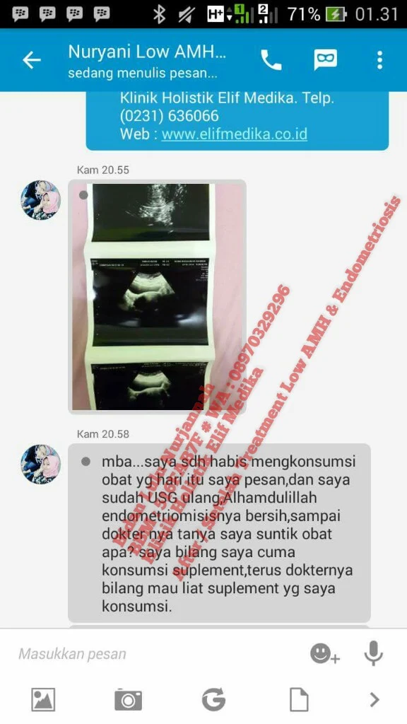 Testimoni Endometriosis by Bidan Lulu Nurjannah Testimoni Endometriosis by Bidan Lulu Nurjannah