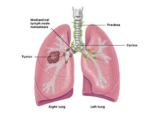 penyakit paru paru
