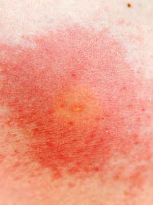 Bed Bugs Gone Now Back Bed Bugs Gone Now Back