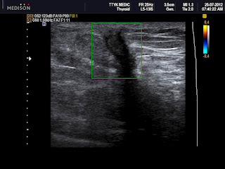 Lumpectomy Scar Keloid