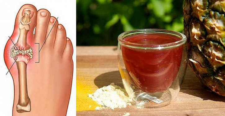 An Old Trick To Remove Uric Acid Crystals From The Body And Prevent Gout And Joint Pain
