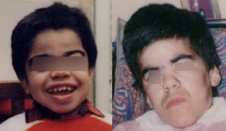  Clinical features of a boy with Sanfilippo syndrome images