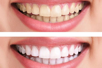  Tẩy trắng răng áp dụng khi nào?