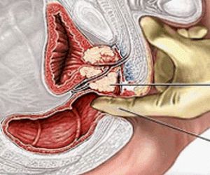 sintomas de próstata enferma