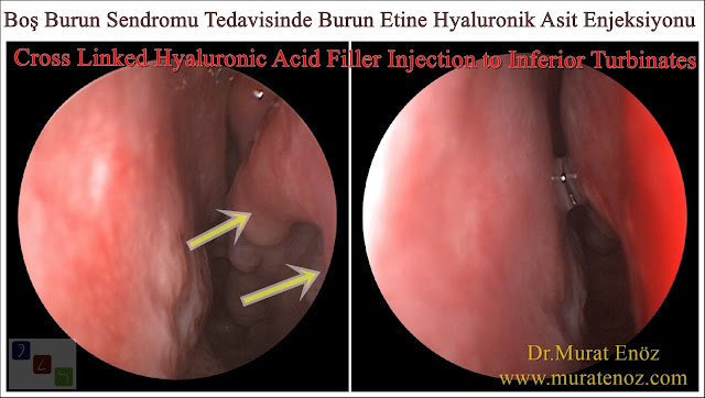 Boş burun sendromu tanımı - Boş burun sendromu belirtileri - Boş burun sendromu tedavisi - Boş burun sendromu tedavisinde Hyaluronik Asit dolgusu - Burun eti dolgusu - Treatment of Empty nose syndrome with hyaluronic acid filler - Boş burun - Geniş burun boşluğu sendromu - Burun eti büyütülmesi - Empty Nose Syndrome (ENS)