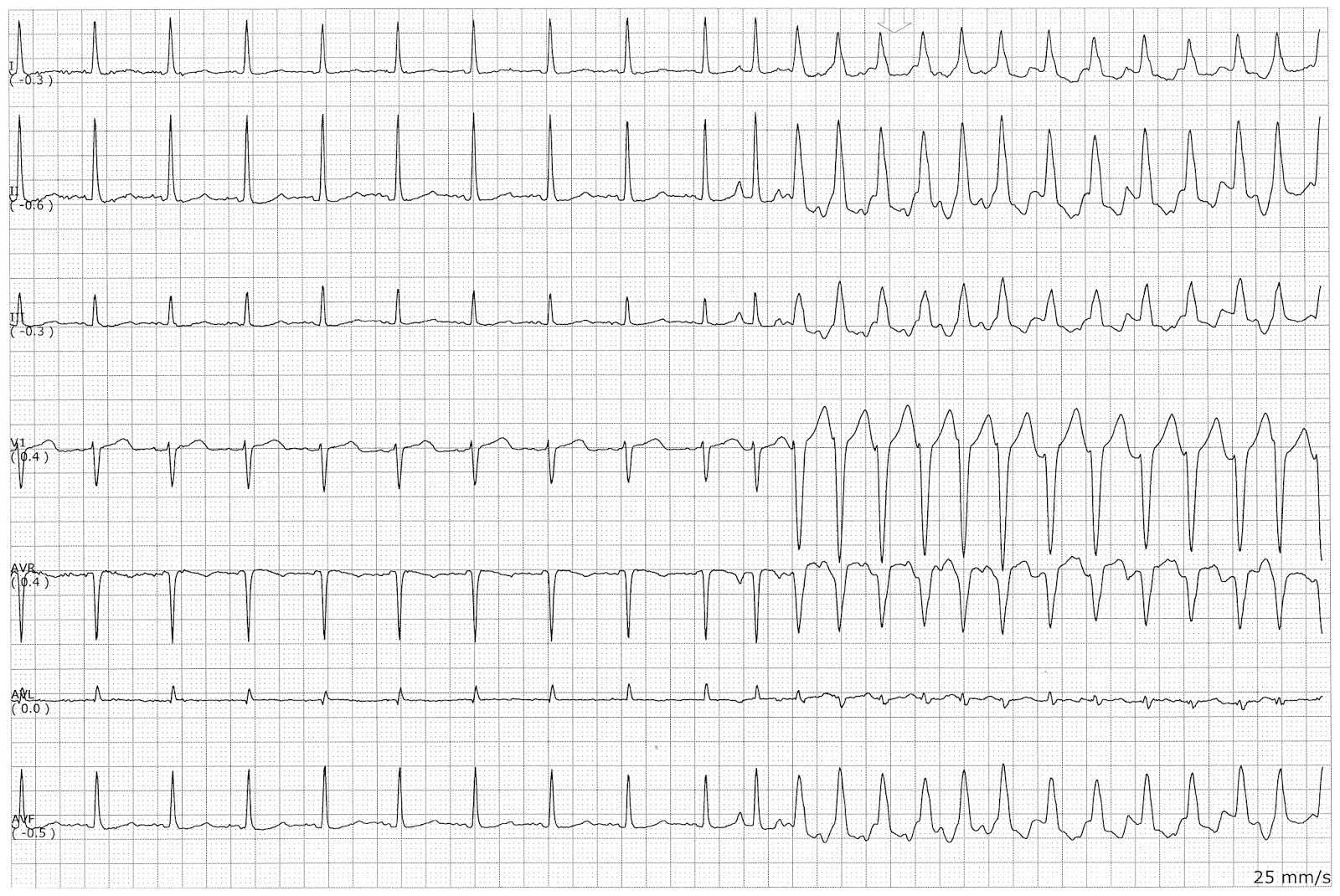 Sinus Rhythm Changing to VT or ST with Aberrancy