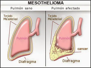 Serene Mesothelioma Que Es En Español Wallpaper for Mobile Serene Mesothelioma Que Es En Español Wallpaper for Mobile