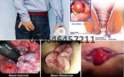 Obat Radang Benjolan Ambeien Obat Radang Benjolan Ambeien