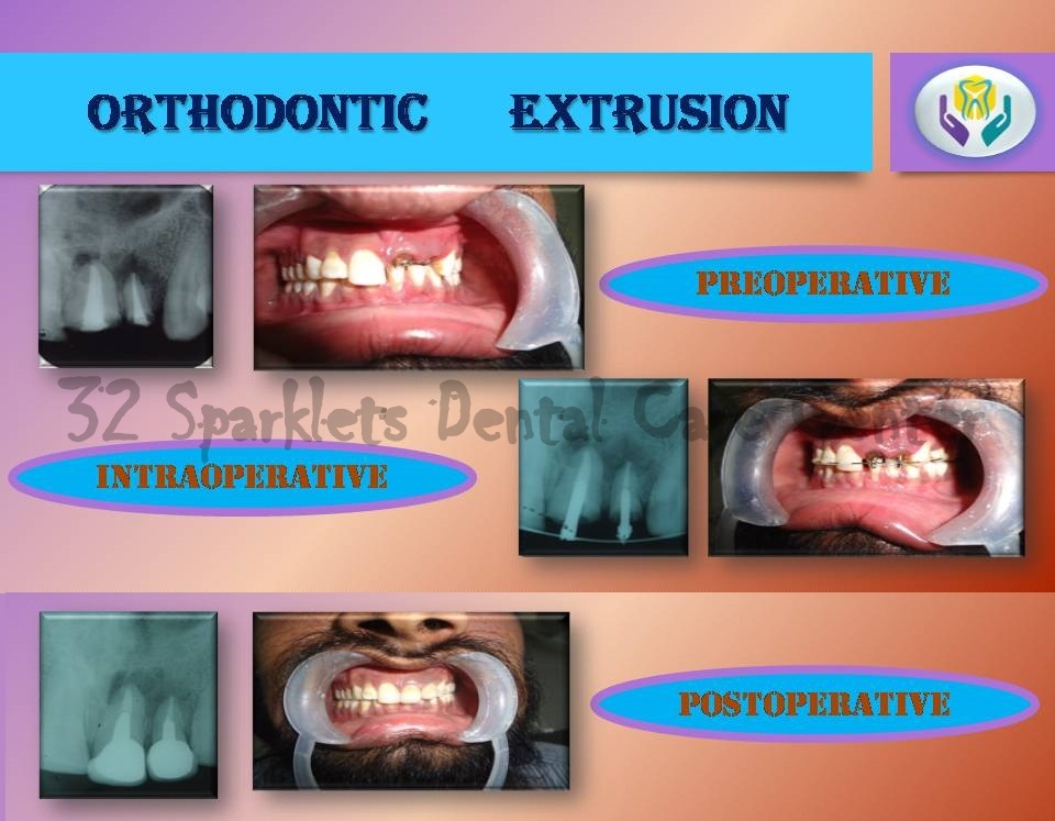 Dental Dreamz Orthodontic Extrusion An alternative to Extraction