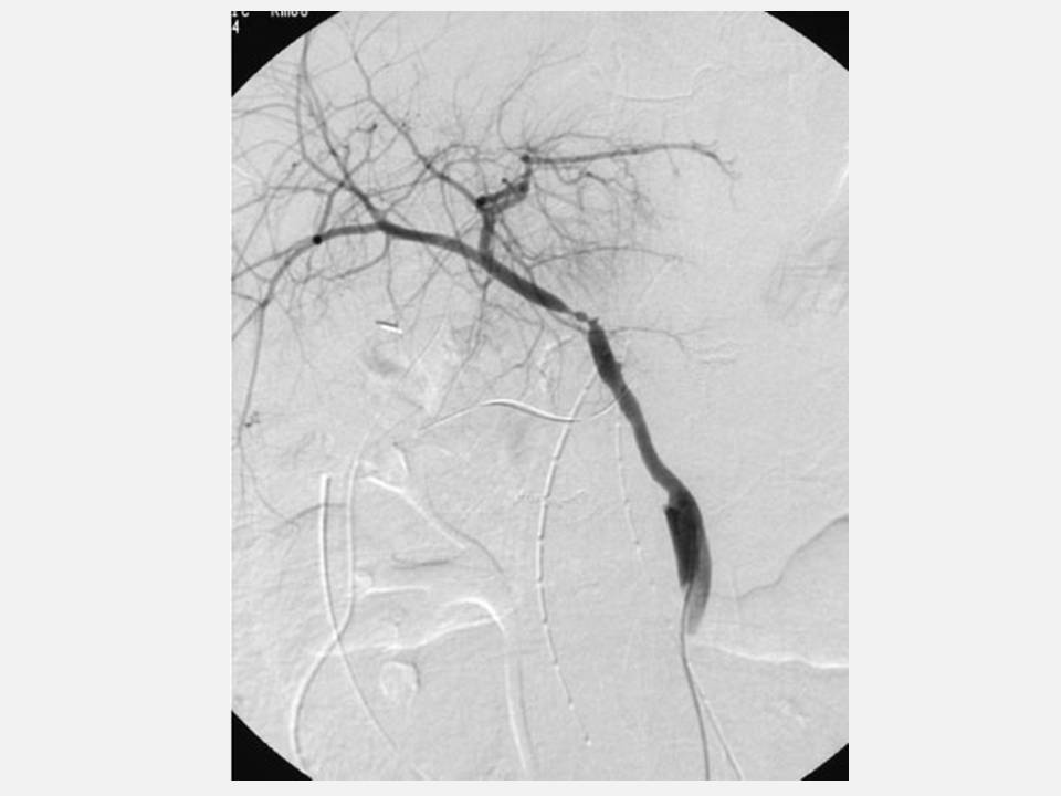 The Pump and the Tubes Hepatic Artery Complications Following Liver Transplant