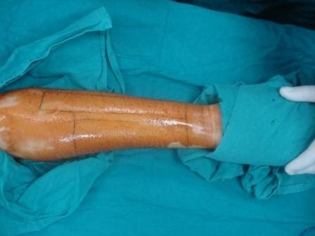 Penis Reconstruction Surgery 30