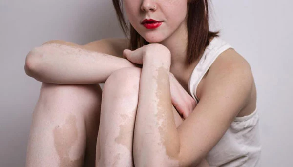 ¿Qué sabes sobre el vitiligo o “mal del pinto”?