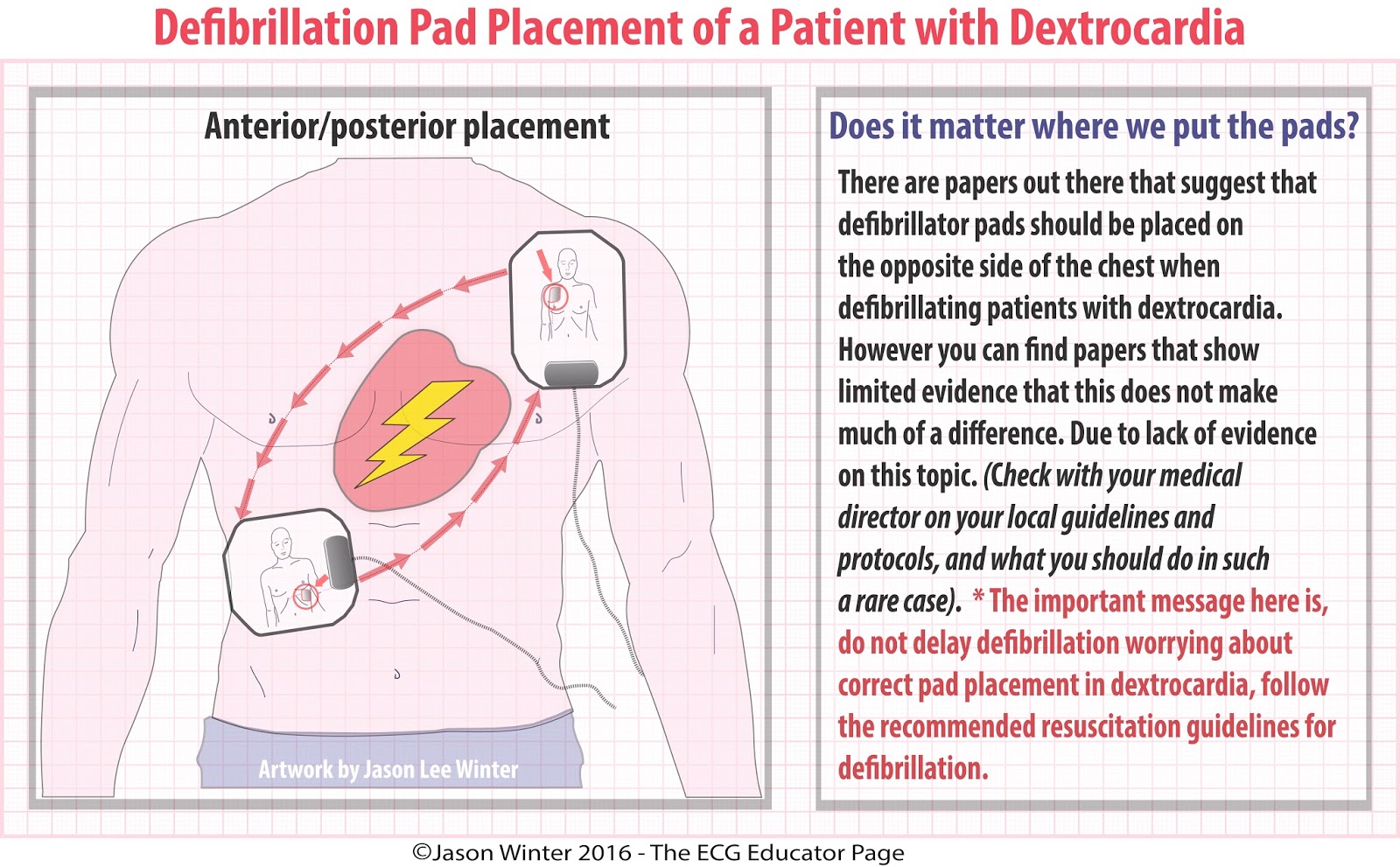 ECG Educator Blog Dextrocardia