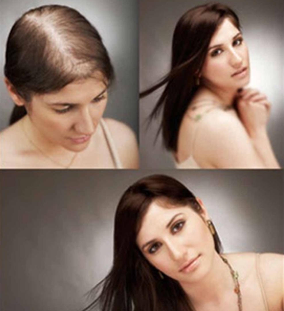 androgenetic alopecia - Genetics Home Reference