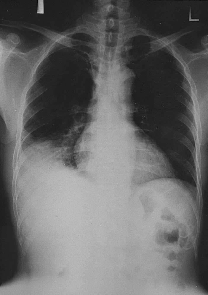 Study Medical Photos Interpreting Chest X ray Of A Patient Diagnosed