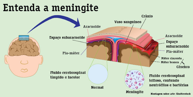 Entenda a meningite viral e bacteriana