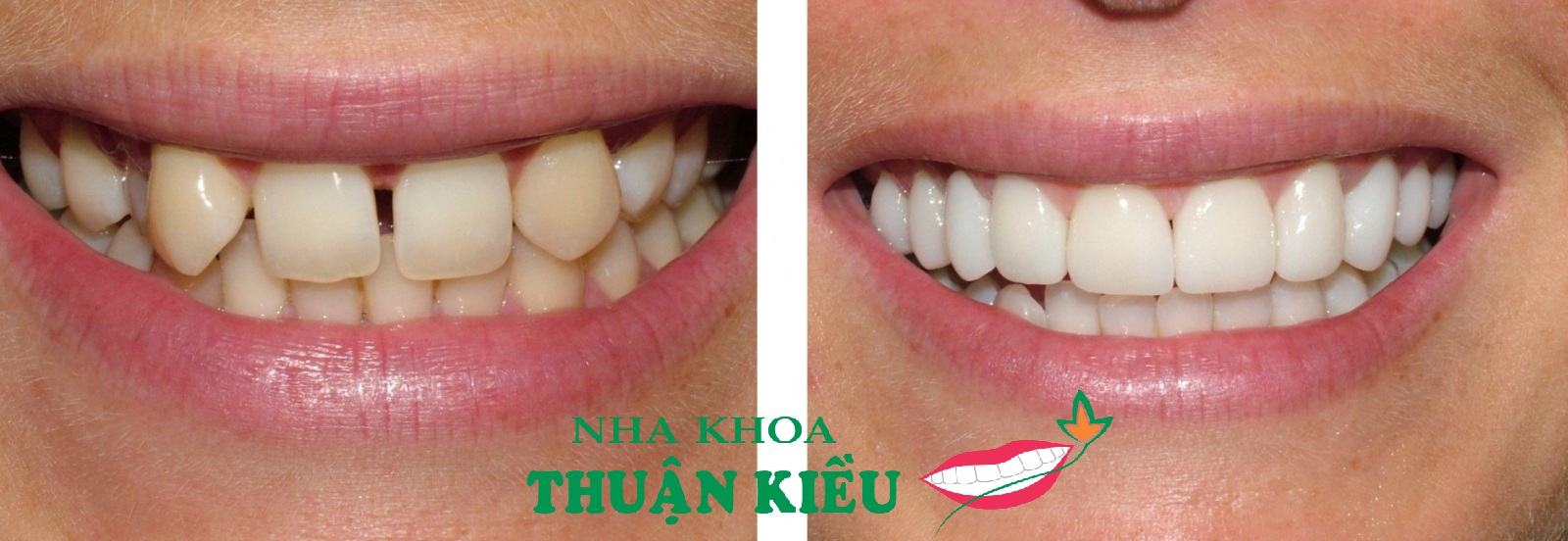 Veneer Crowns Cheaper in Vietnam September 2015