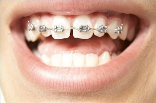 Sức khỏe, đời sống: Niềng răng có phải nhổ răng không? Mot-so-luu-y-khi-nieng-rang-tham-my-2