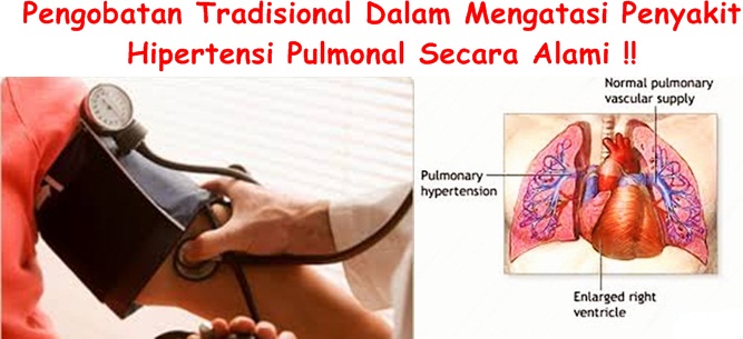 Obat Tradisional Hipertensi Pulmonal