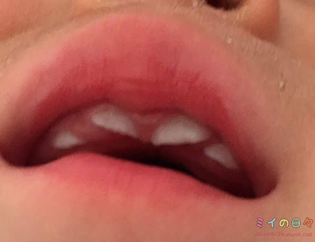 赤ちゃん 乳歯 歯並び 悪い ガタガタ 隙間 すきっ歯 V字 重なり