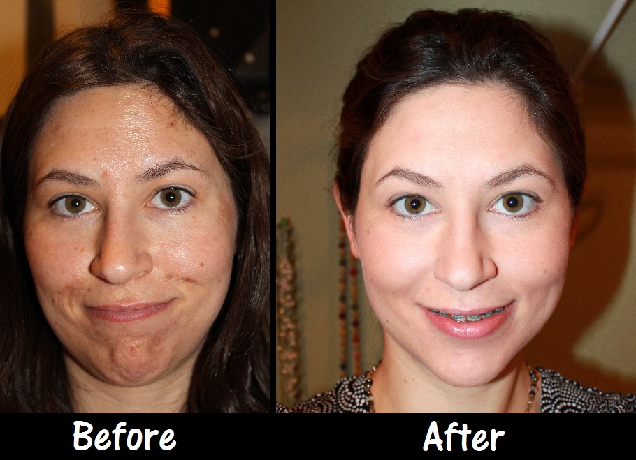 Lactic Acid Peel Before After