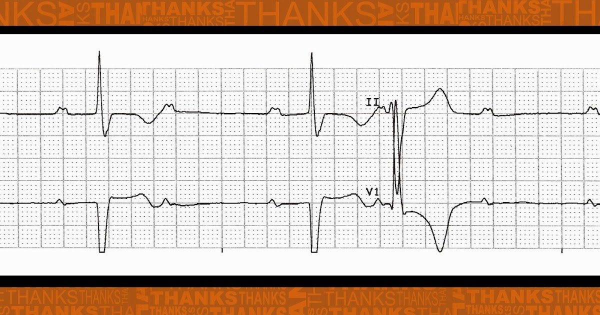 Ekg Strips Flashcards EKG dysrhythmias StudyBlue amandaazer