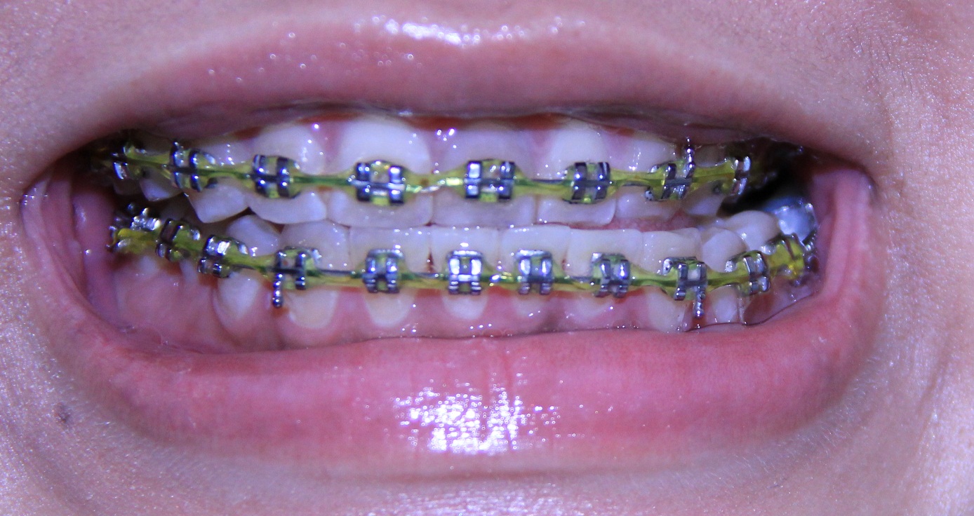 9th Braces Visit! Part 2!
