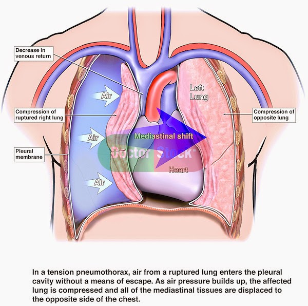 Emergency decompression of Tension pneumothorax: Tutorial video -  MedchromeTube