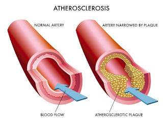 http://obesitysurgeryasia.com/atherosclerosis-treatments.html