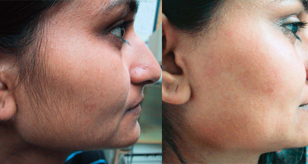 This Natural Recipe Will Permanently Get Rid Of Unwanted Facial