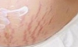 How to get rid of stretch marks, home remedies for stretch marks, remove stretch marks fast, fast stretch marks treatment, stretch marks home remedies, how to treat stretch marks, 