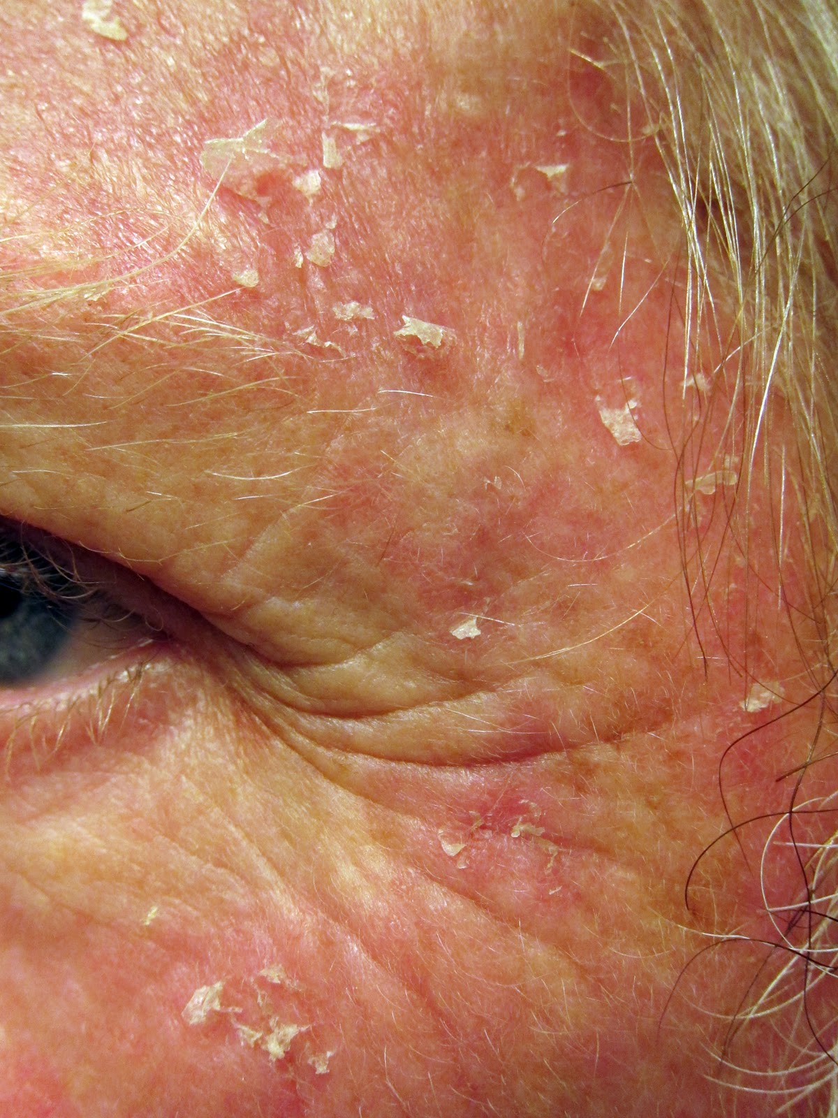 efudex-round-two-day-23-recovery-day-9-peeling-skin