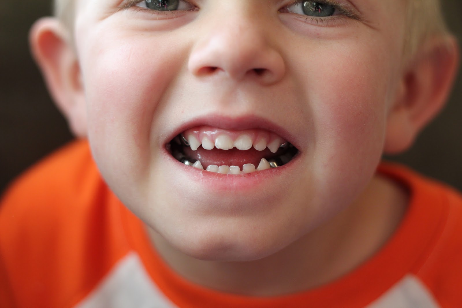 Eardley Crew Silver teeth...