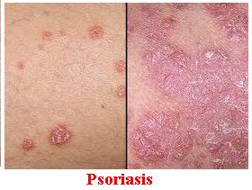 Cara Mengatasi Penyakit Psoriasis